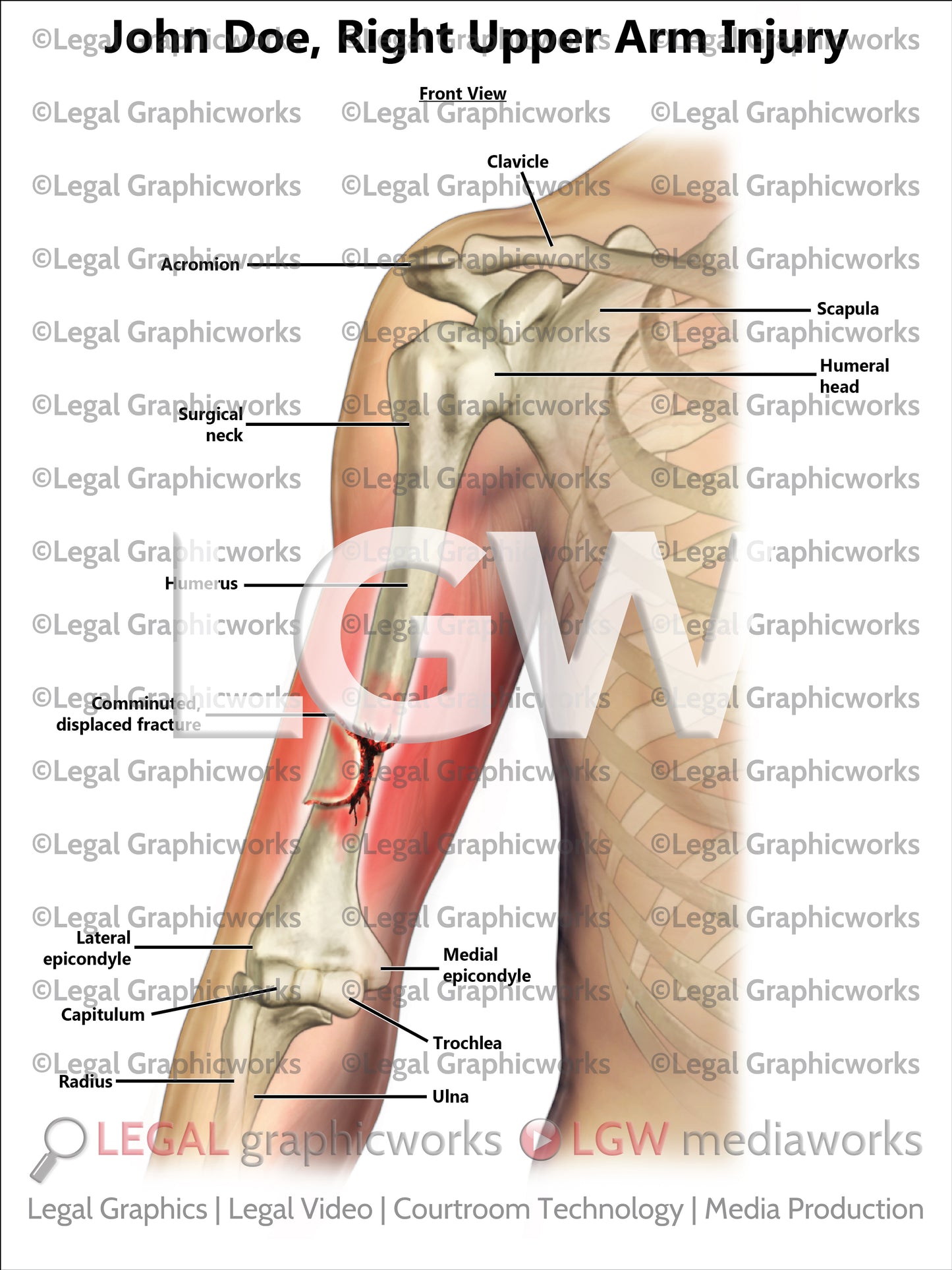 Right Upper Arm Injury