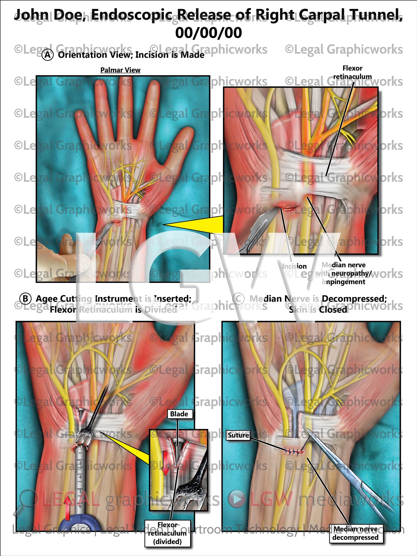Endoscopic Release of Right Carpal Tunnel