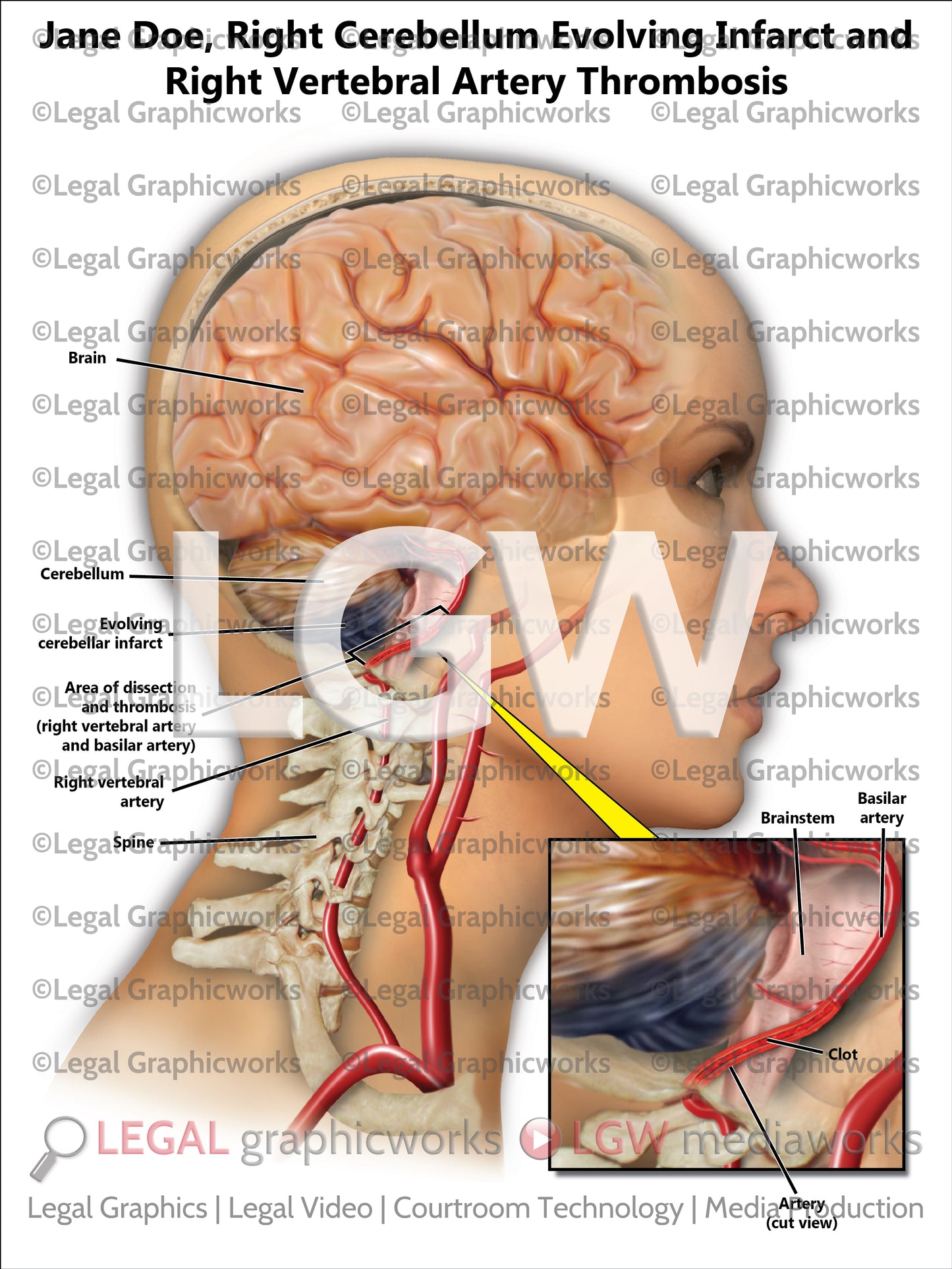 Right Cerebellum Evolving Infarct and Right Vertebral Artery Thrombosis
