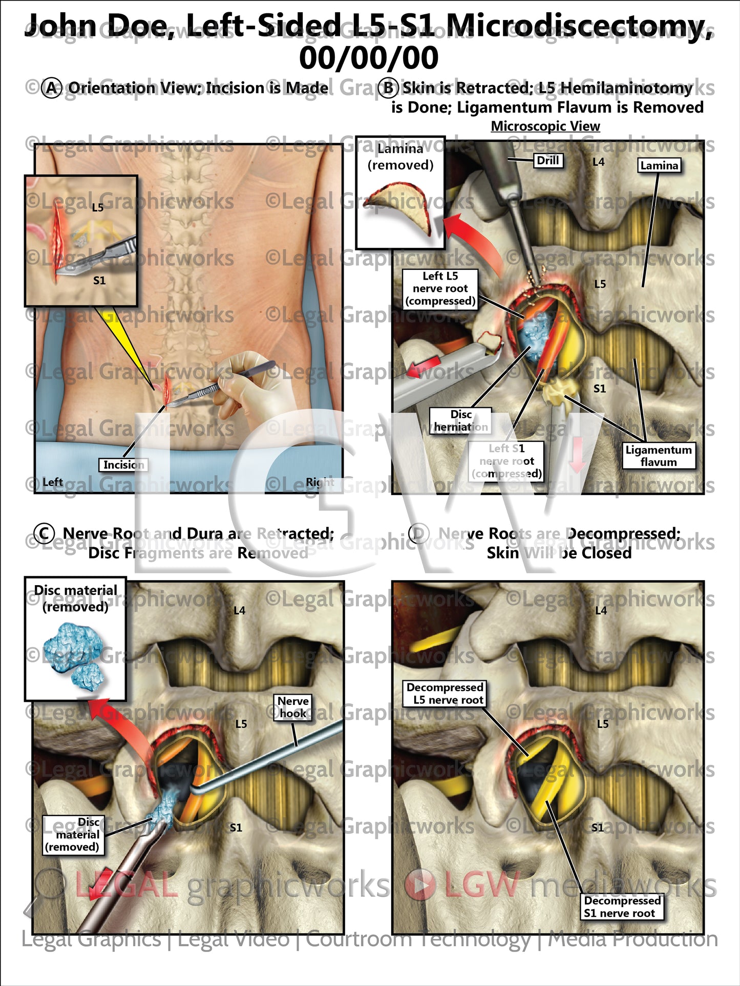 Left-Sided L5-S1 Microdiscectomy