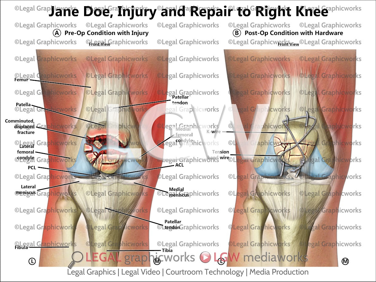 Injury and Repair to Right Knee