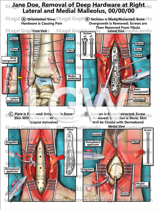 Removal of Deep Hardware at Right Lateral and Medial Malleolus
