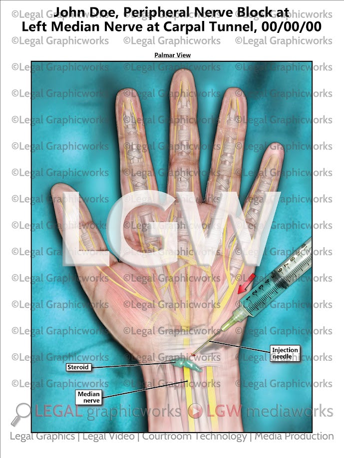 Peripheral Nerve Block at Left Median Nerve at Carpal Tunnel