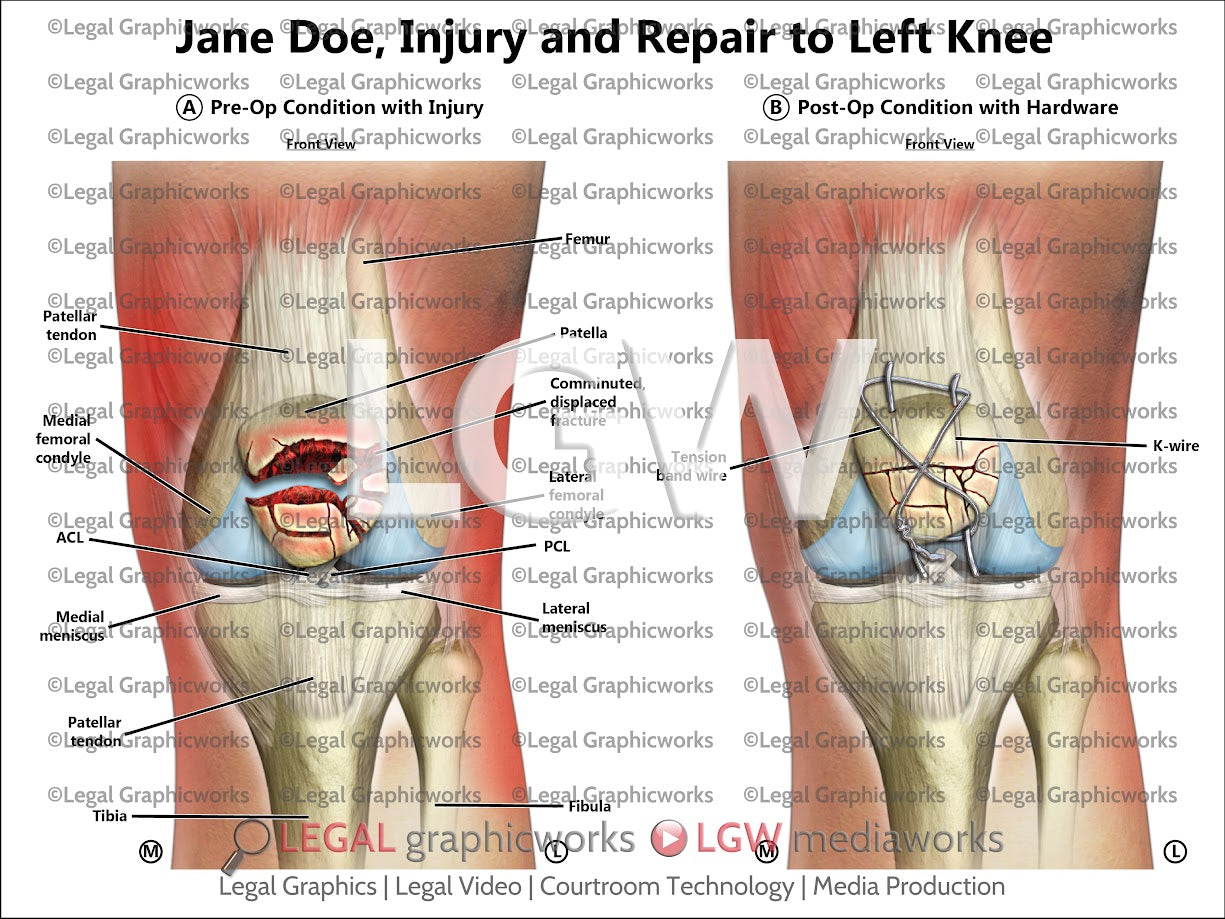 Injury and Repair to Left Knee