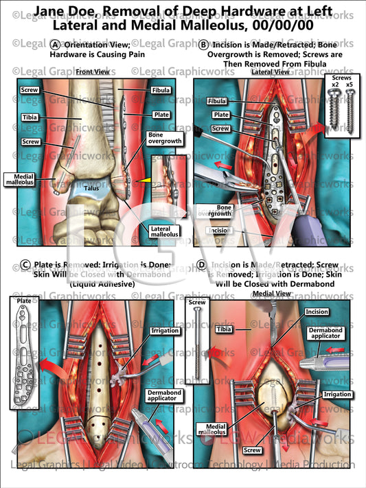 Removal of Deep Hardware at Left Lateral and Medial Malleolus