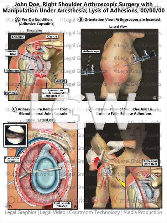 Right Shoulder Arthroscopic Surgery with Manipulation Under Anesthesia; Lysis of Adhesions