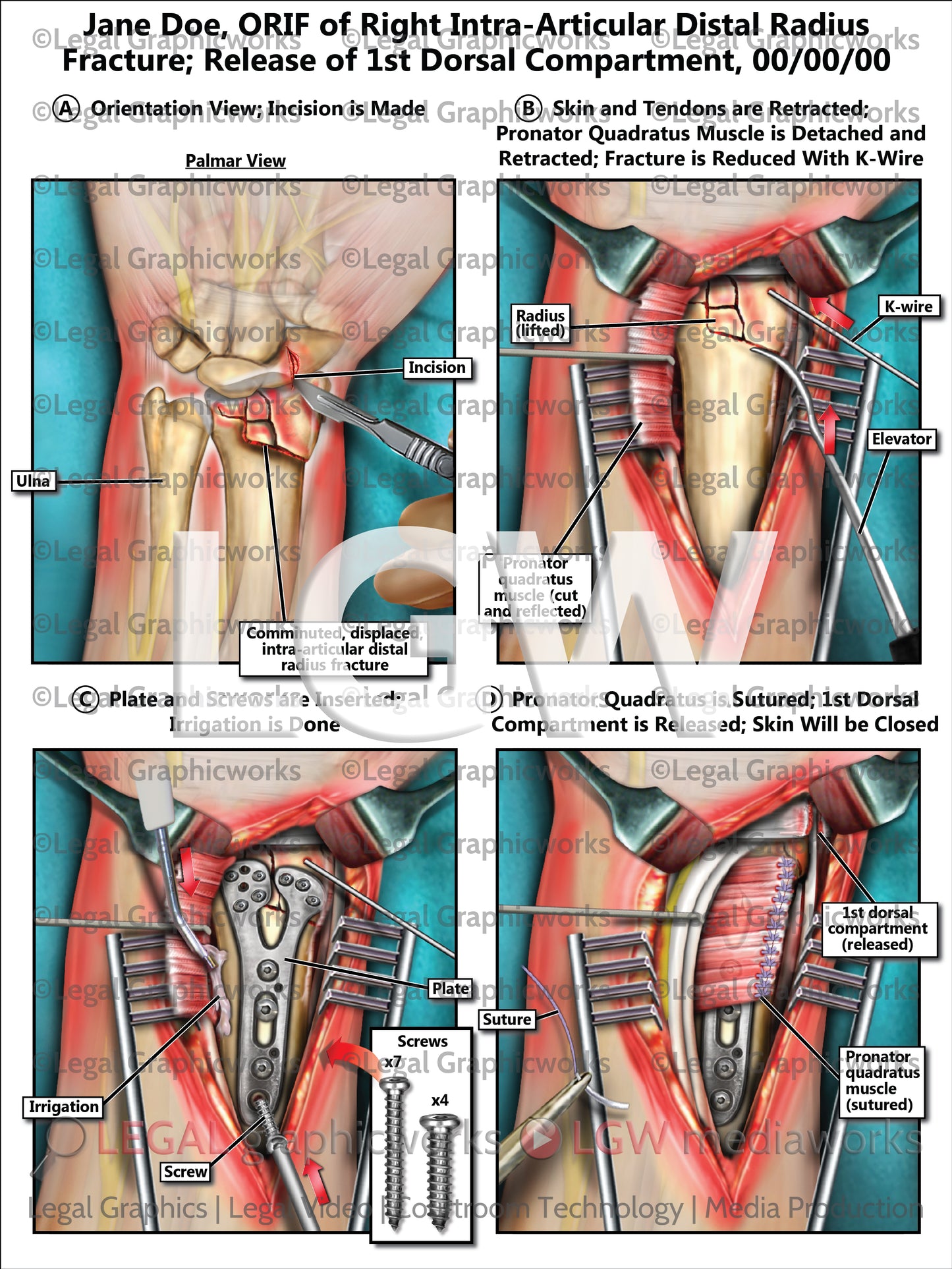 ORIF of Right Intra-Articular Distal Radius Fracture; Release of 1st Dorsal Compartment