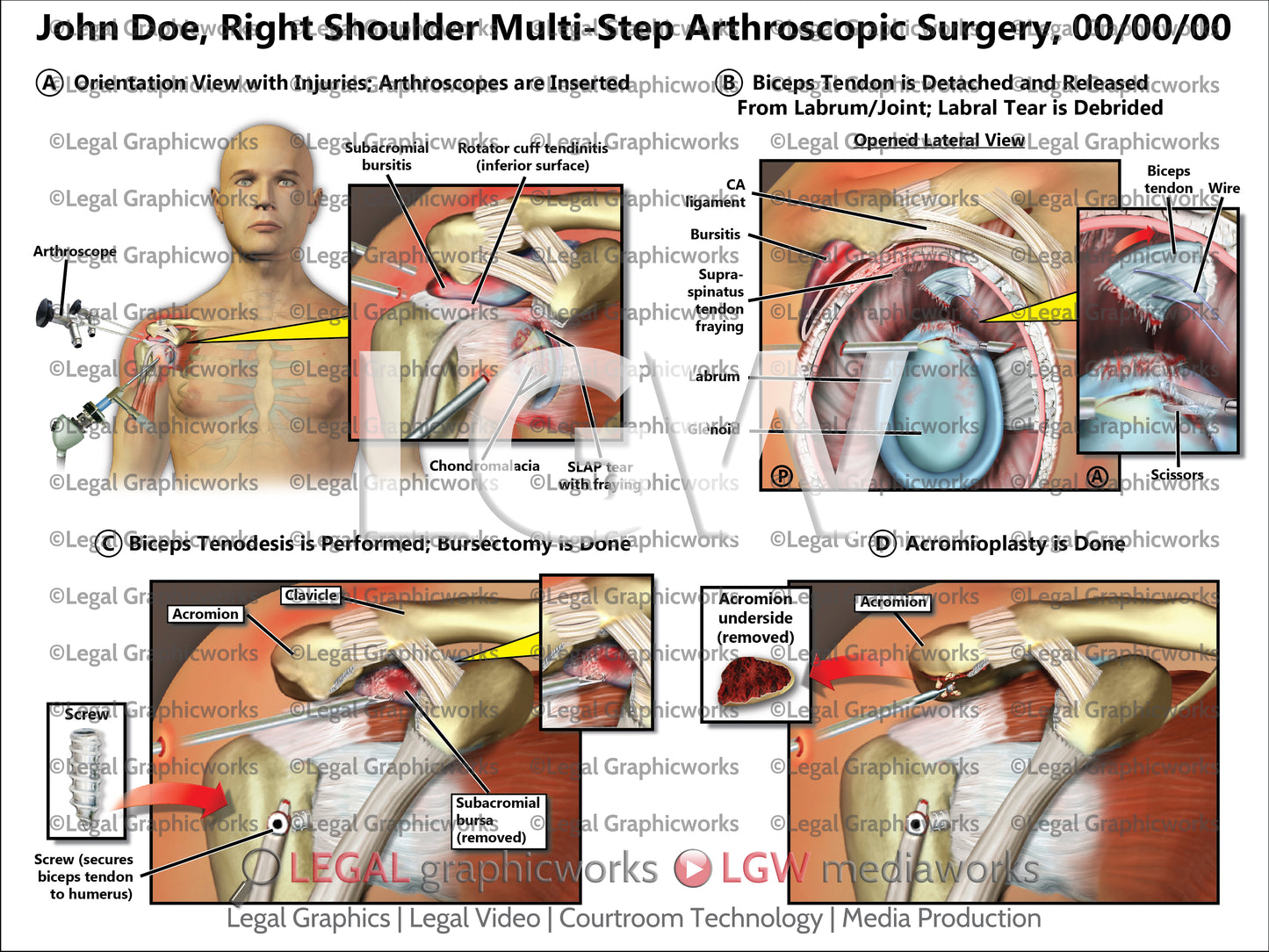 Right Shoulder Multi-Step Arthroscopic Surgery