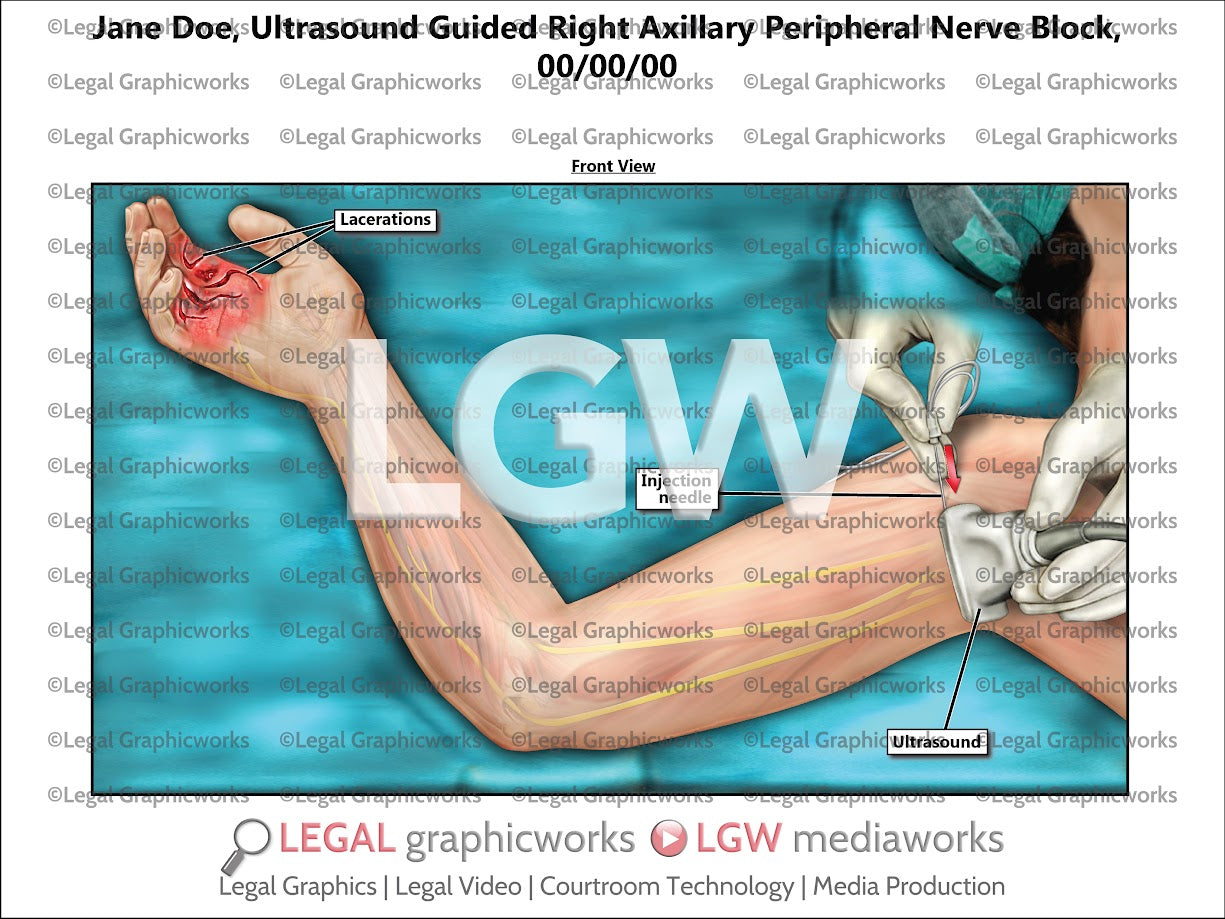 Ultrasound Guided Right Axillary Peripheral Nerve Block