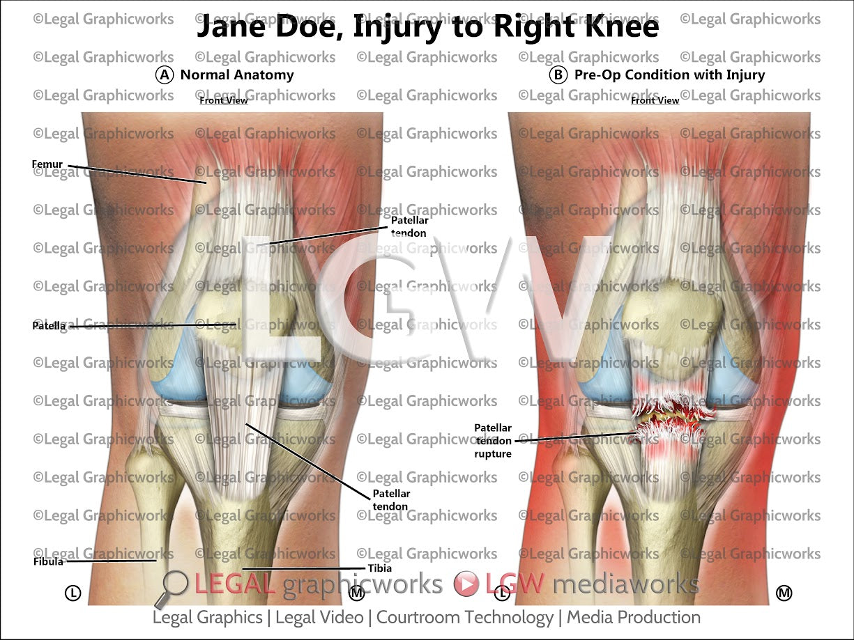 Injury to Right Knee