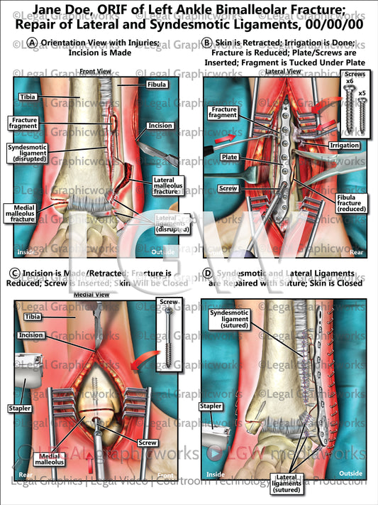 ORIF of Left Ankle Bimalleolar Fracture; Repair of Lateral and Syndesmotic Ligaments