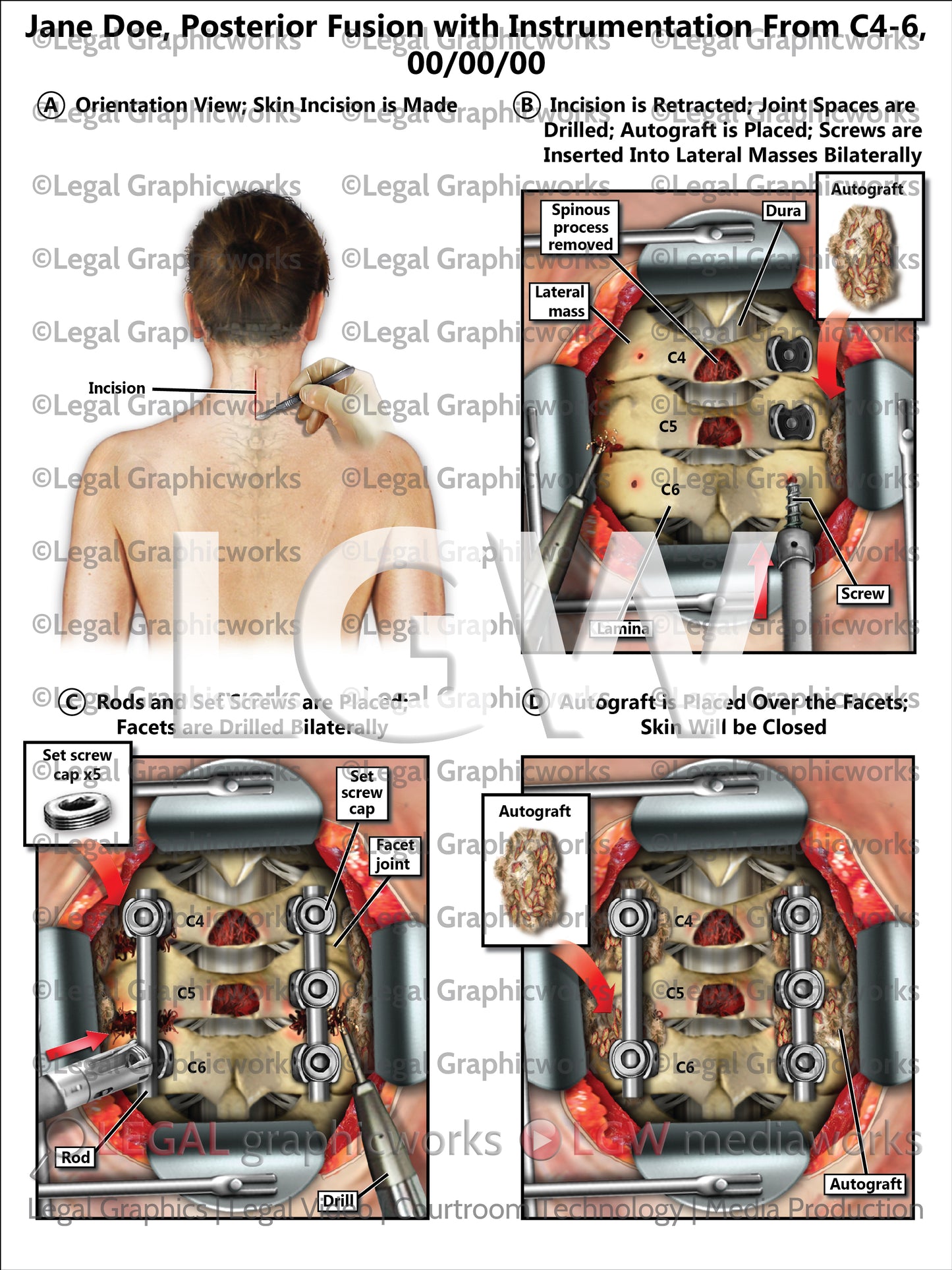 Posterior Fusion with Instrumentation From C4-6