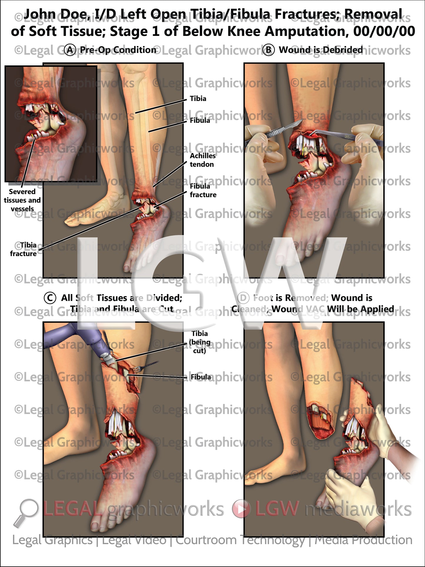 I/D Left Open Tibia/Fibula Fractures; Removal of Soft Tissue; Stage 1 of Below the Knee Amputation