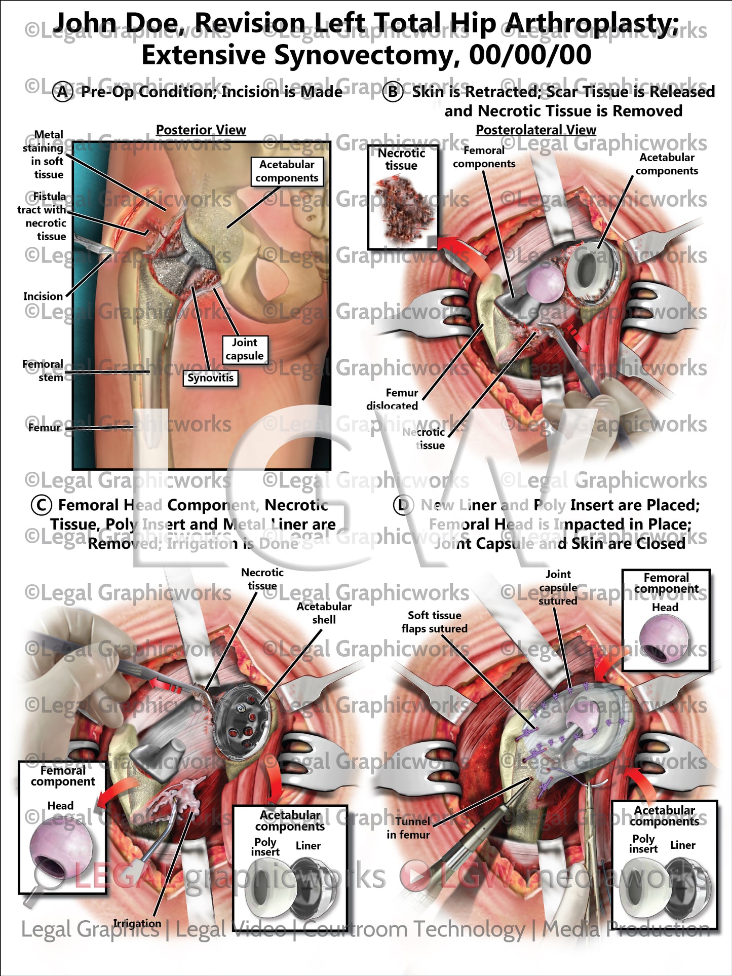 Revision Left Total Hip Arthroplasty; Extensive Synovectomy