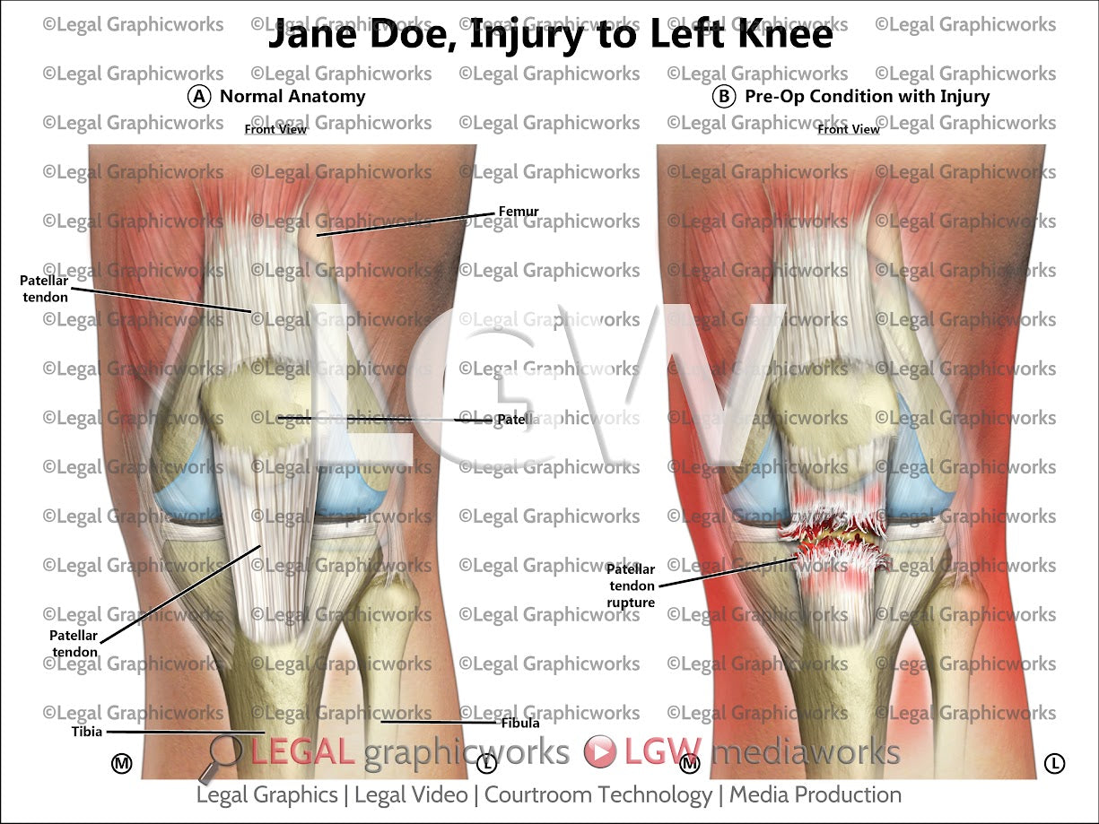 Injury to Left Knee