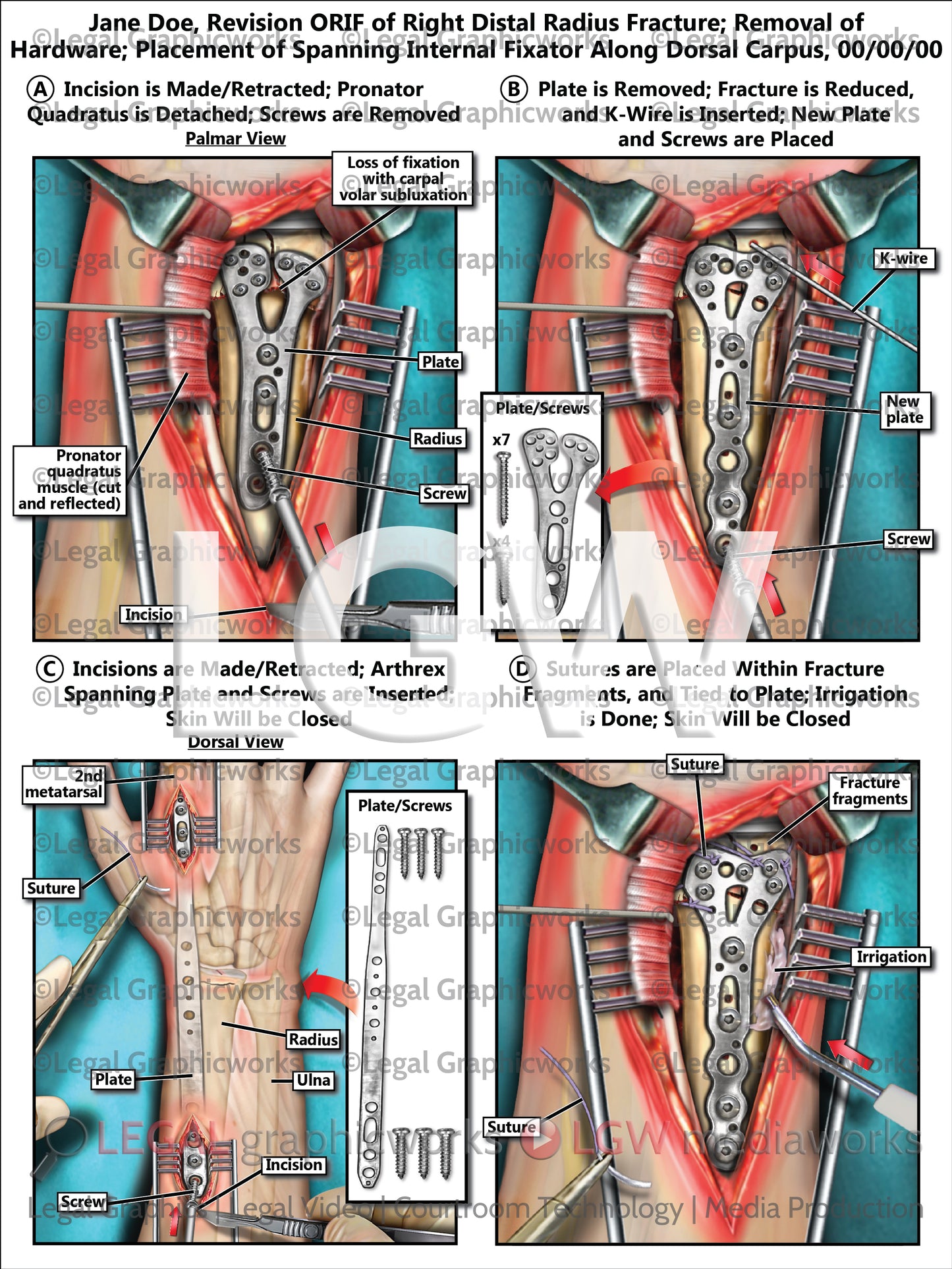 Revision ORIF of Right Distal Radius Fracture; Removal of Hardware; Placement of Spanning Internal Fixator Along Dorsal Carpus
