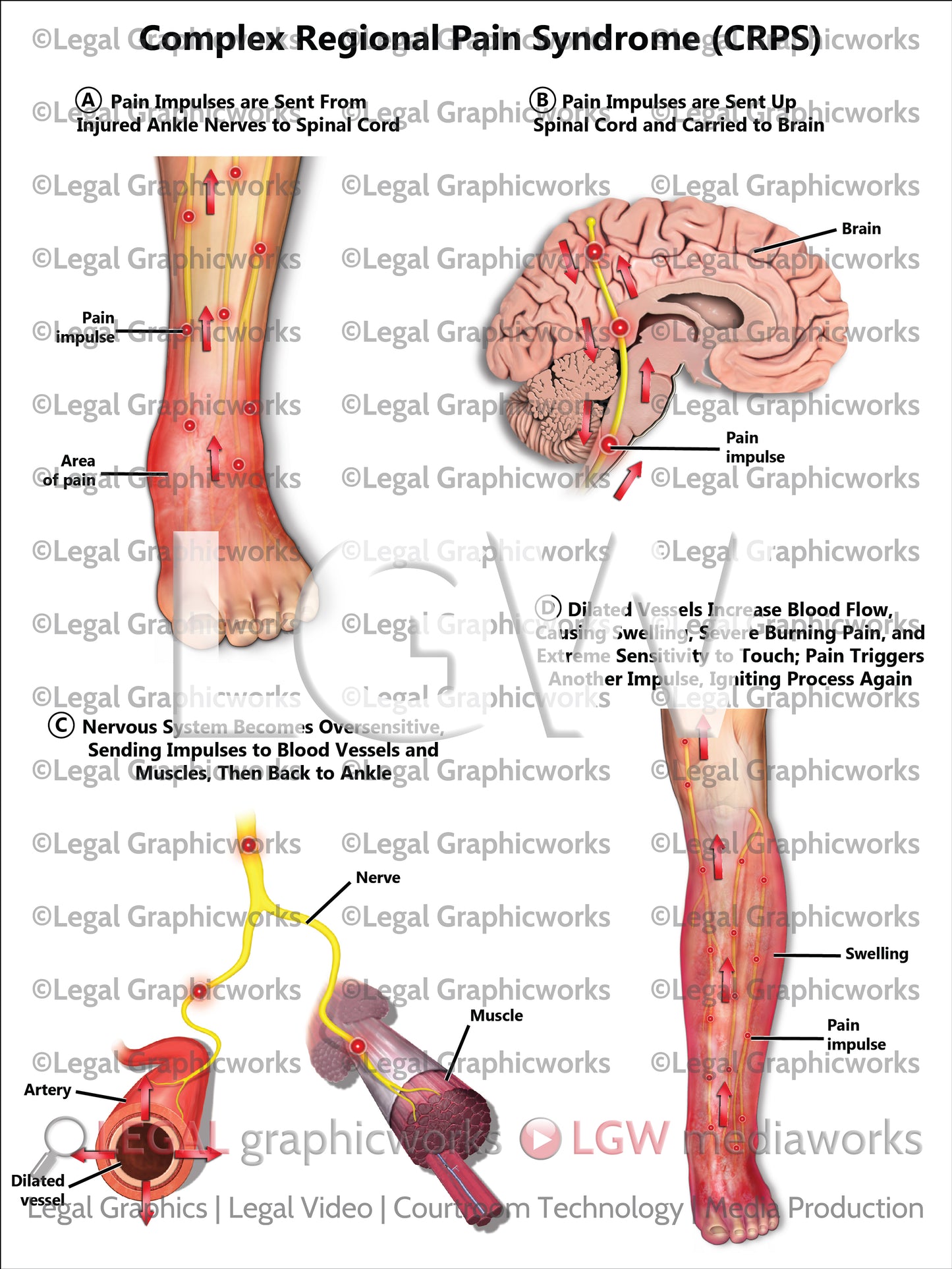 Complex Regional Pain Syndrome (CRPS)