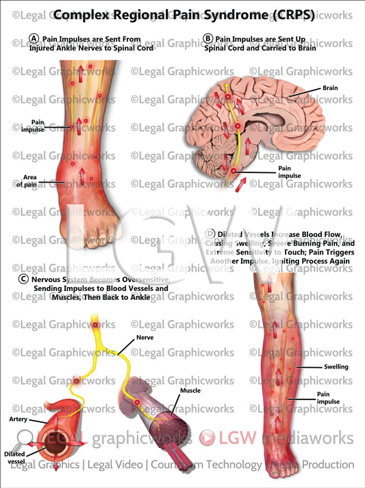 Complex Regional Pain Syndrome (CRPS)