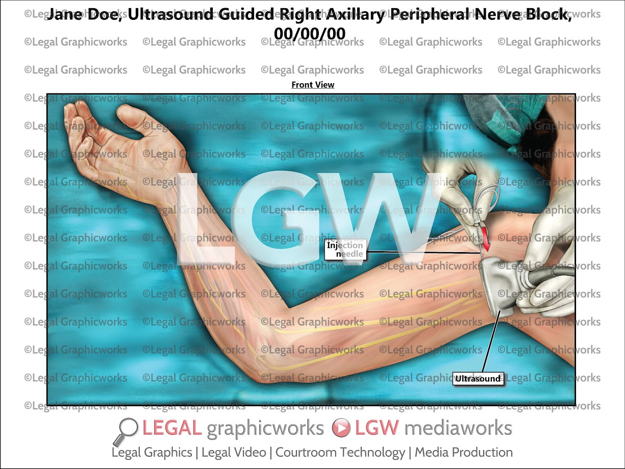 Ultrasound Guided Axillary Peripheral Nerve Block