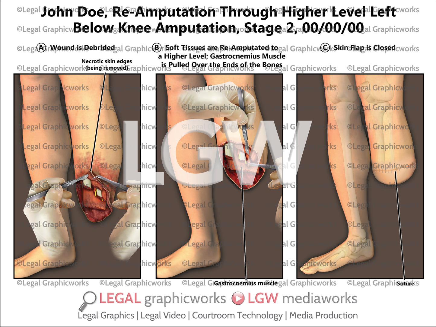Re-Amputation Through Higher Level Left Below Knee Amputation, Stage 2