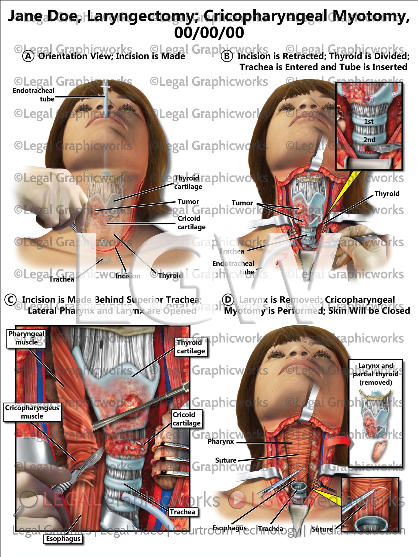 Laryngectomy; Cricopharyngeal Myotomy