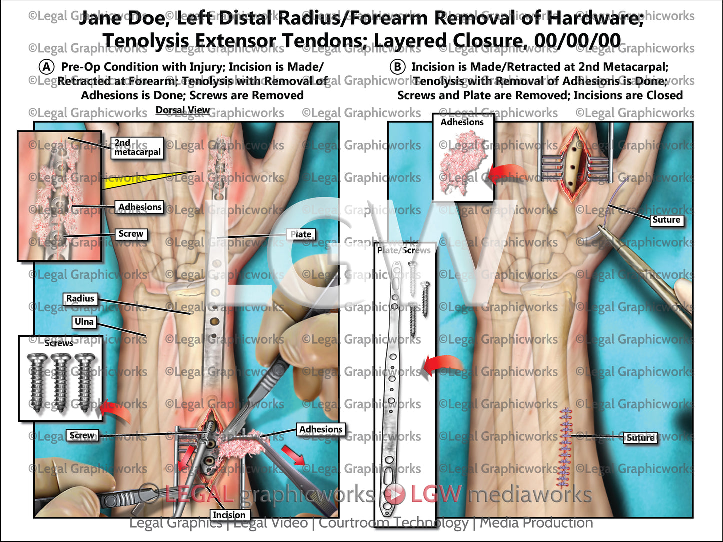 Left Distal Radius/Forearm Removal of Hardware; Tenolysis Extensor Tendons; Layered Closure