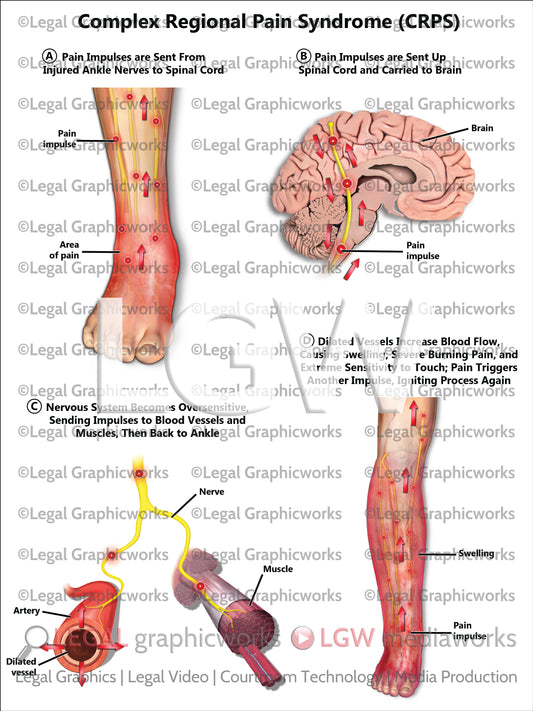 Complex Regional Pain Syndrome (CRPS)
