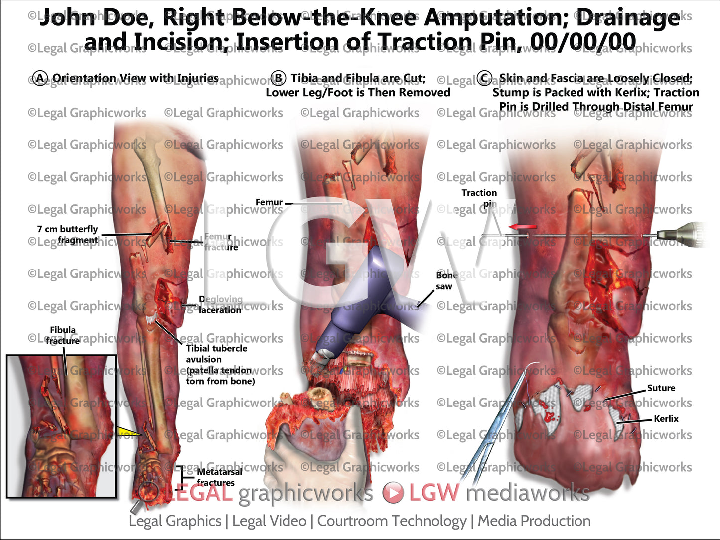 Right Below-the-Knee Amputation; Drainage and Incision; Insertion of Traction Pin