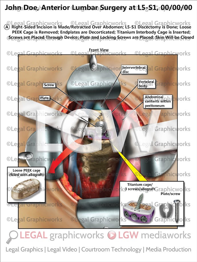 Anterior Lumbar Surgery at L5-S1