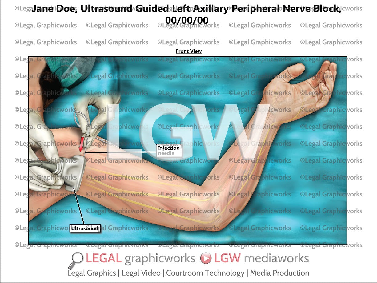 Ultrasound Guided Left Axillary Peripheral Nerve Block