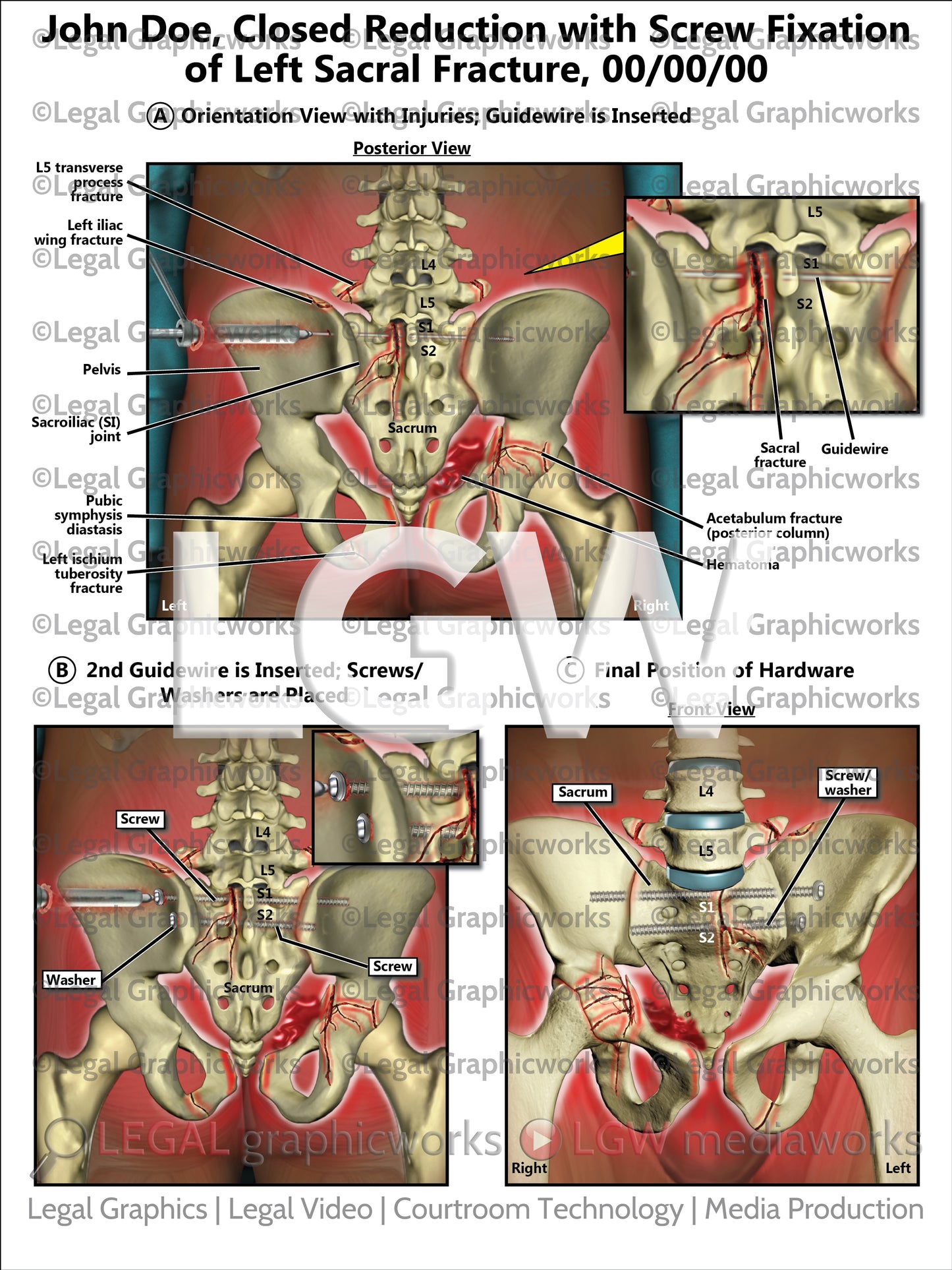Closed Reduction with Screw Fixation of Left Sacral Fracture