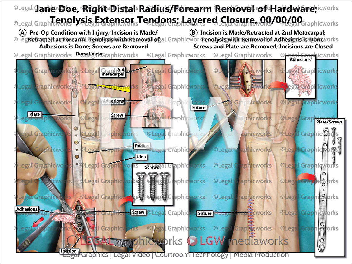 Right Distal Radius/Forearm Removal of Hardware; Tenolysis Extensor Tendons; Layered Closure