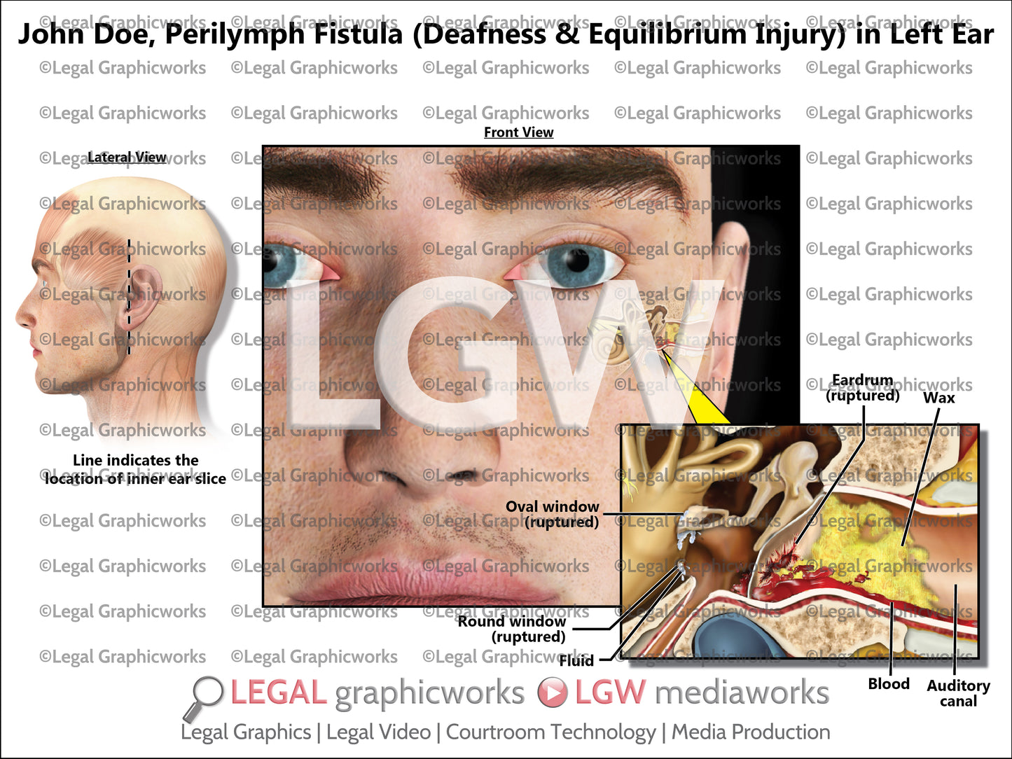 Perilymph Fistula (Deafness and Equilibrium Injury) in Left Ear