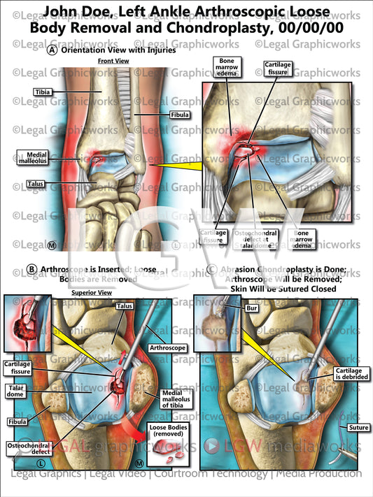Left Ankle Arthroscopic Loose Body Removal and Chondroplasty