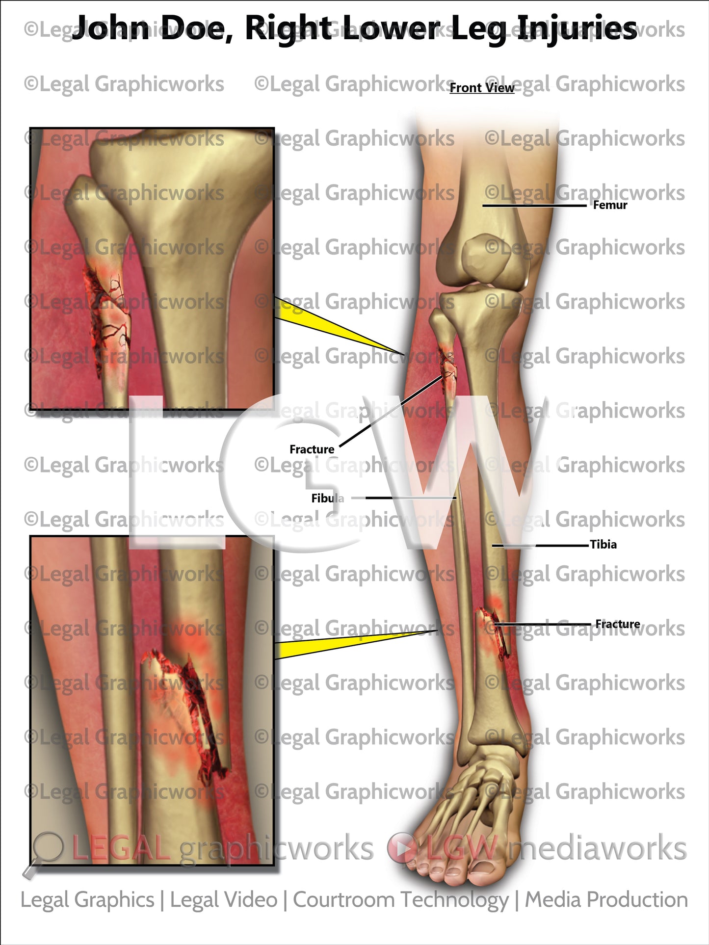 Right Lower Leg Injuries