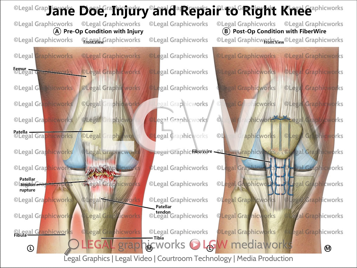 Injury and Repair to Right Knee