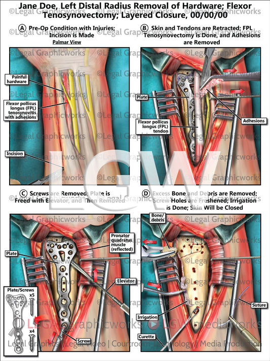 Left Distal Radius Removal of Hardware; Flexor Tenosynovectomy; Layered Closure