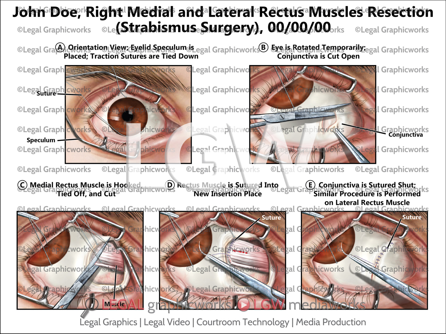 Right Medial and Lateral Rectus Muscles Resection (Strabismus Surgery)