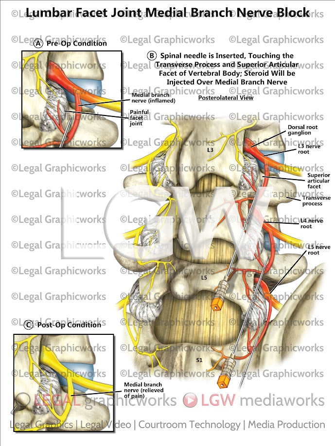 Lumbar Facet Joint Medial Branch Nerve Block