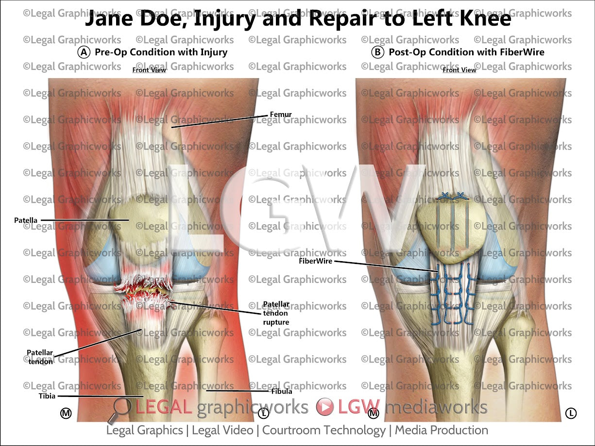 Injury and Repair to Left Knee