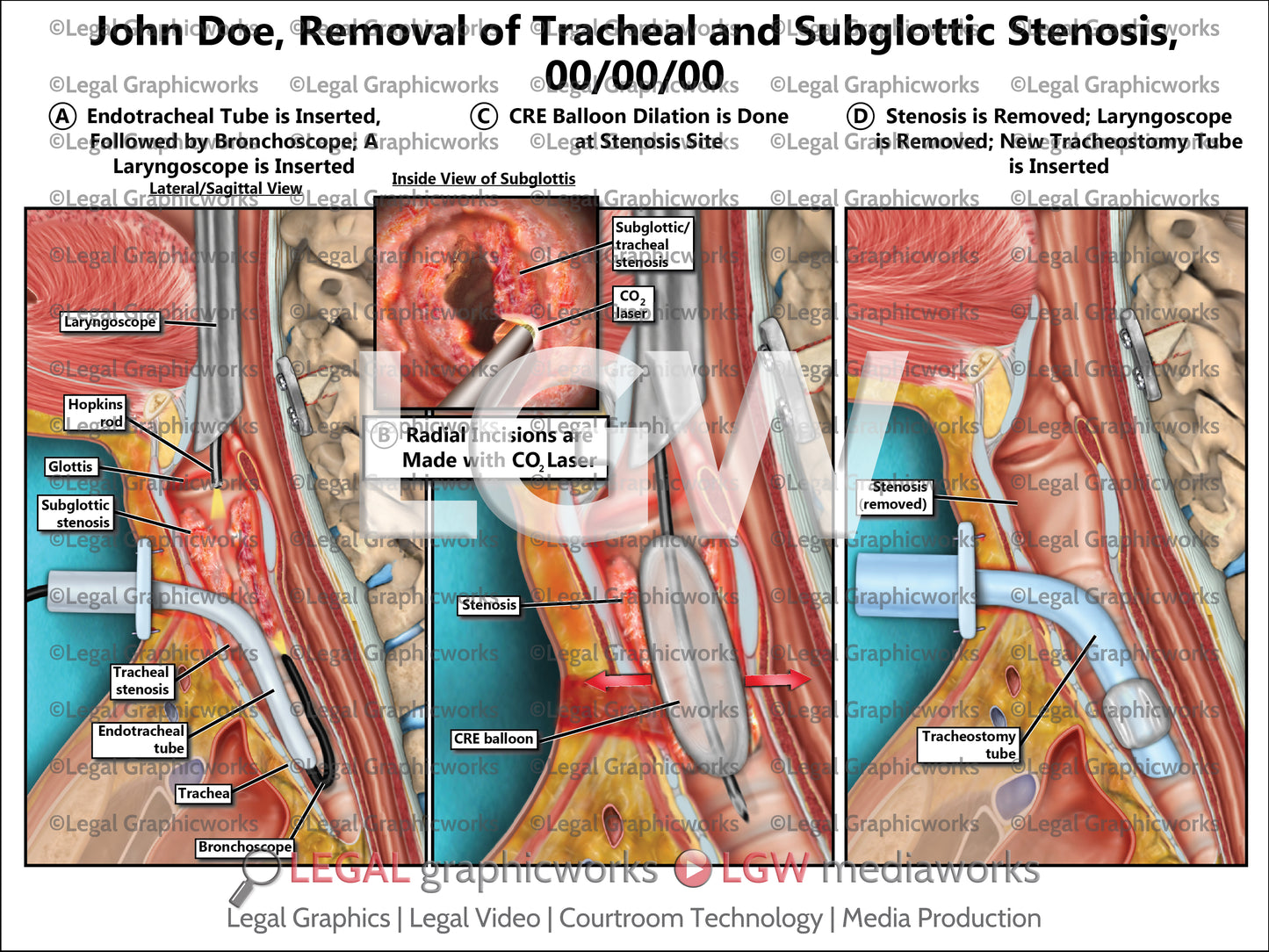 Removal of Tracheal and Subglottic Stenosis