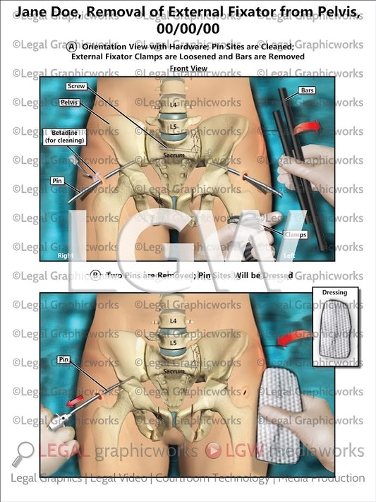 Removal of External Fixator from Pelvis