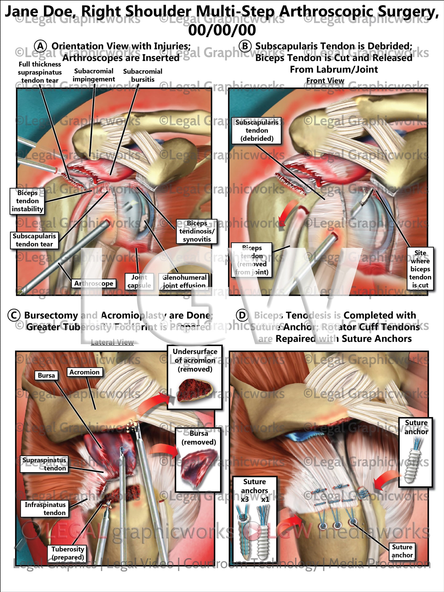 Right Shoulder Multi-Step Arthroscopic Surgery
