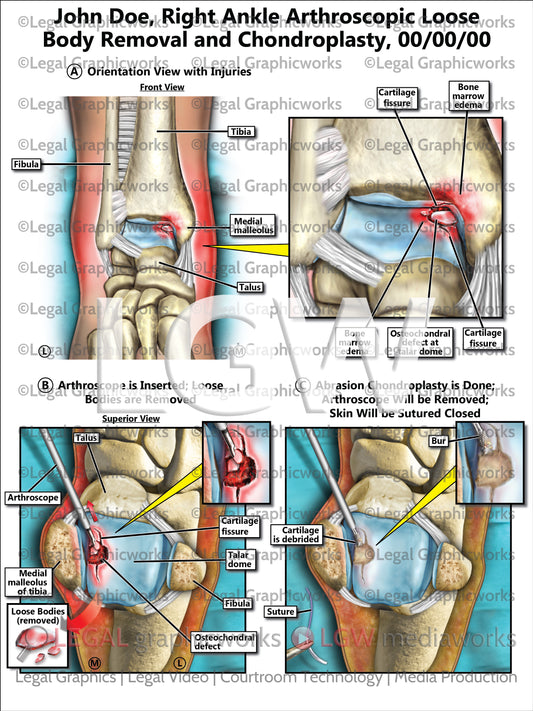 Right Ankle Arthroscopic Loose Body Removal and Chondroplasty