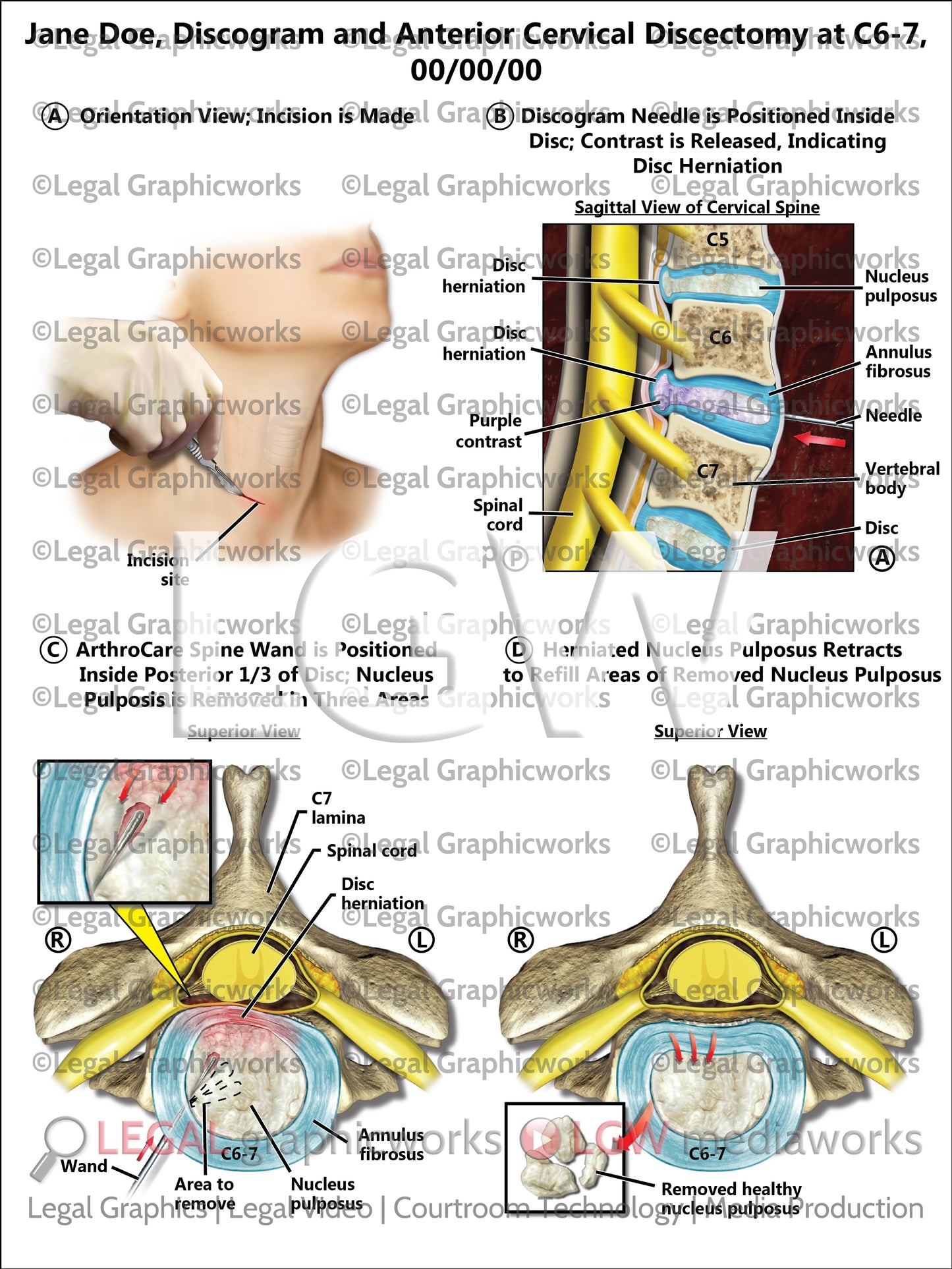 Discogram and Anterior Cervical Discectomy at C6-7
