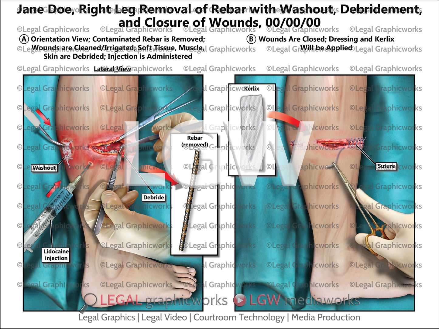 Right Leg Removal of Rebar with Washout, Debridement, and Closure of Wounds