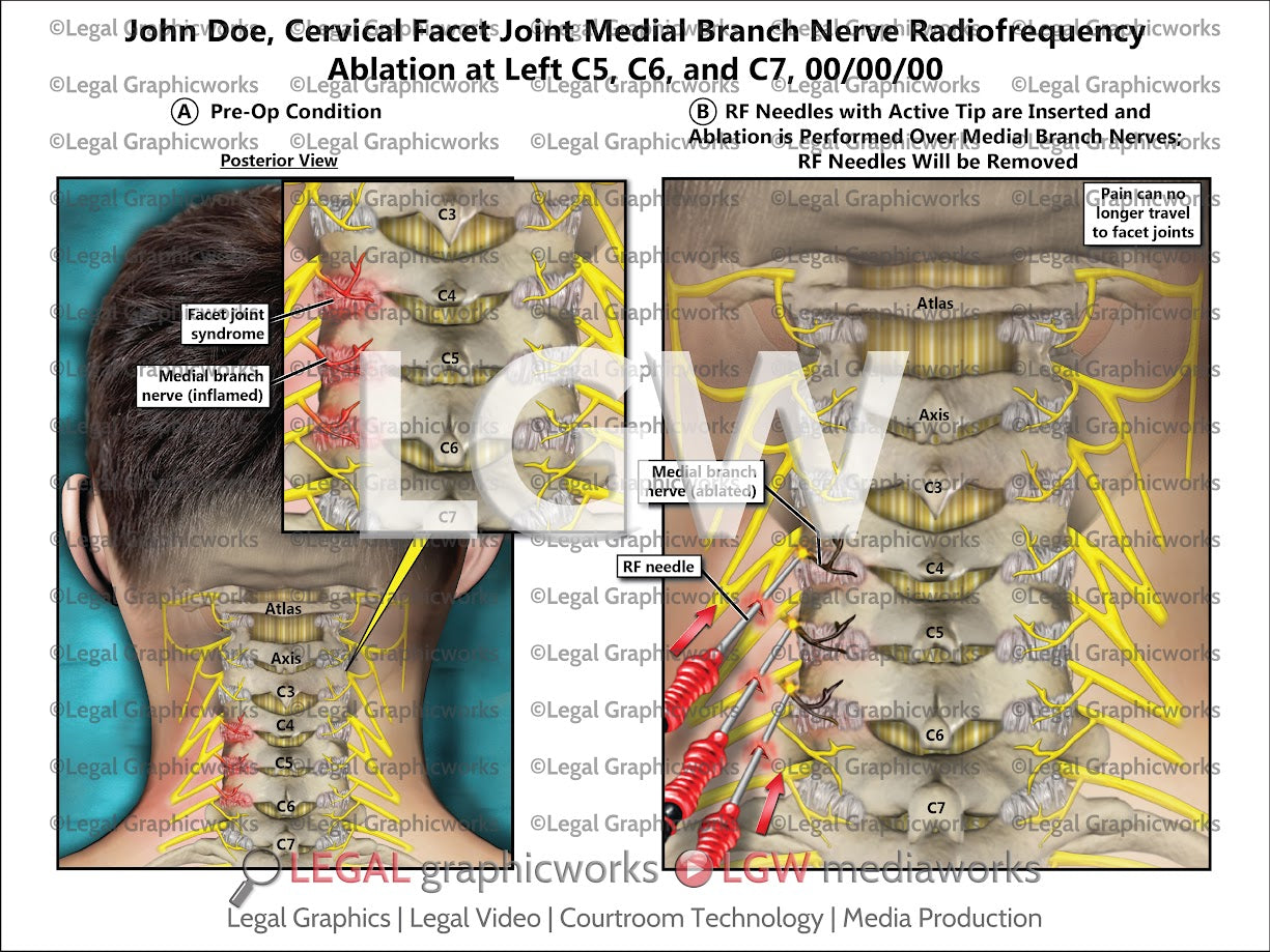 Cervical Facet Joint Medial Branch Nerve Radiofrequency Ablation at Left C5, C6, and C7