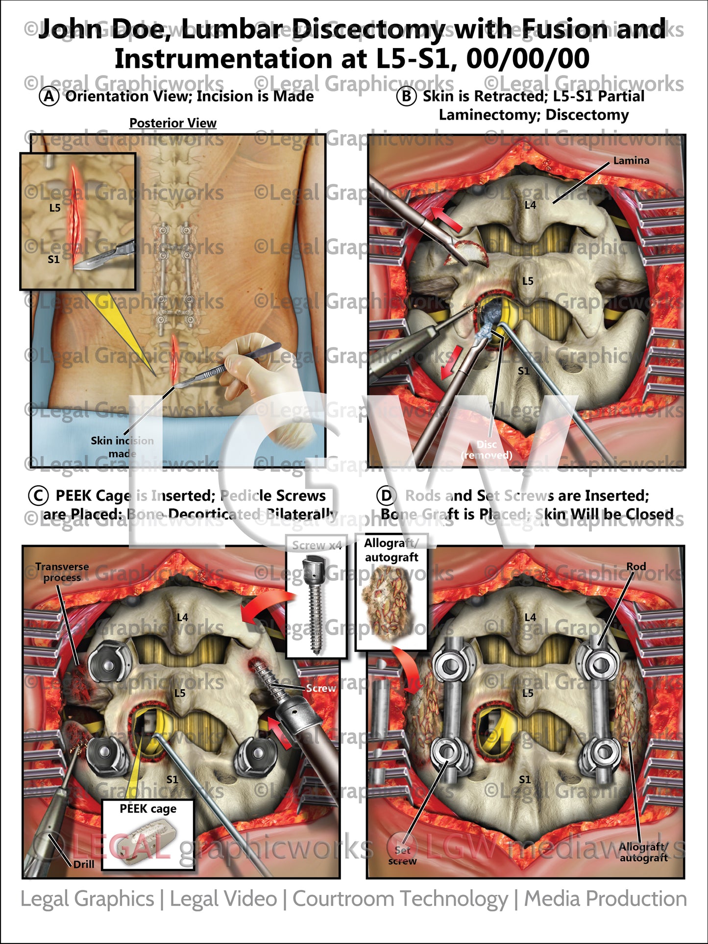 Lumbar Discectomy with Fusion and Instrumentation at L5-S1