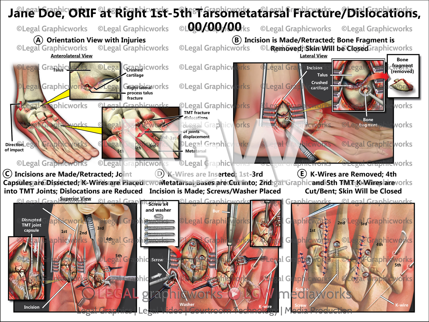 ORIF at Right 1st-5th Tarsometatarsal Fracture/Dislocations