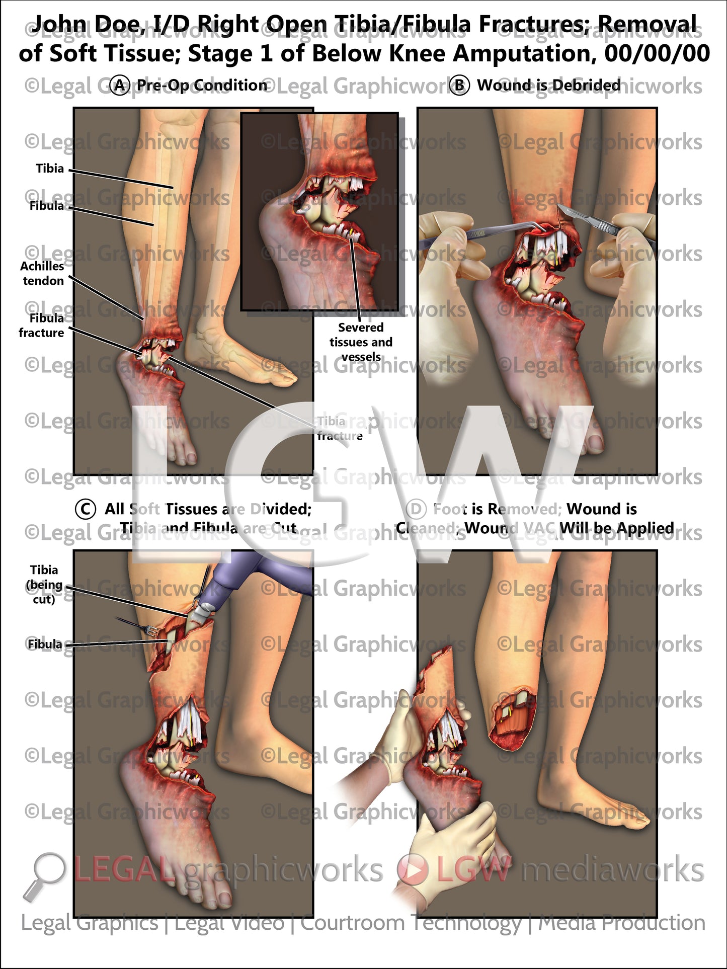 I/D Right Open Tibia/Fibula Fractures; Removal of Soft Tissue; Stage 1 of Below Knee Amputation